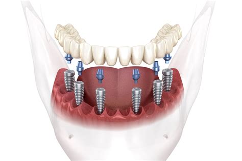 Full Mouth Dental Implants San Francisco | Replacing Full Set of Teeth