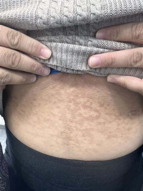 Babak Soltani on LinkedIn: Confluent and reticulated papillomatosis is ...