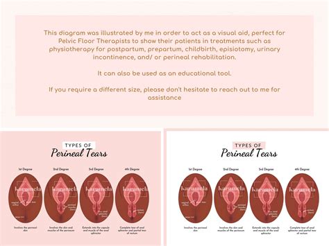 Perineal Tears | PNG Images & Canva Templates | PDF + JPG | Episiotomy ...