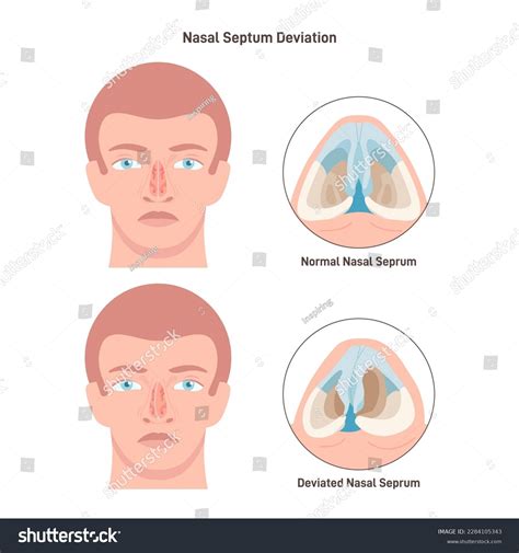 Deviated Septum Pictures
