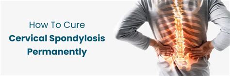 Top Permanent Treatments for Cervical Spondylosis Cure