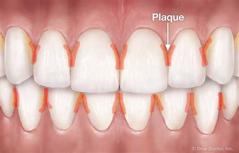 Image result for Extreme Open String Floss