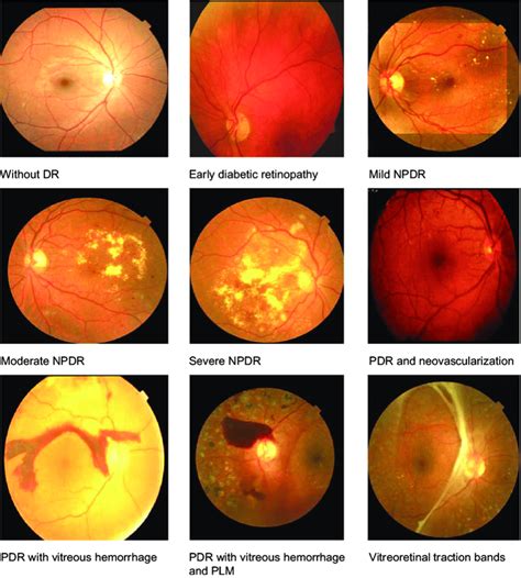 The Importance of Diabetic Retinopathy Screening: A Call to Action