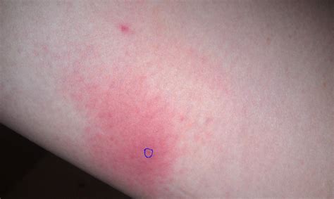 谁知道这个是什么原因导致的？毒蚊子咬的吗？已经3天了，奇痒无比，无极膏，皮炎平都试过了，还是痒啊。_百度知道