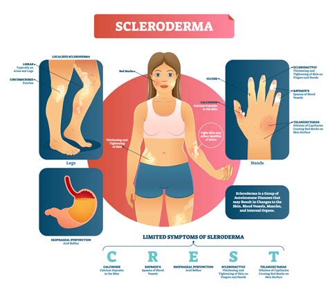 scleroderma - Arthritis Research | Arthritis National Research Foundation