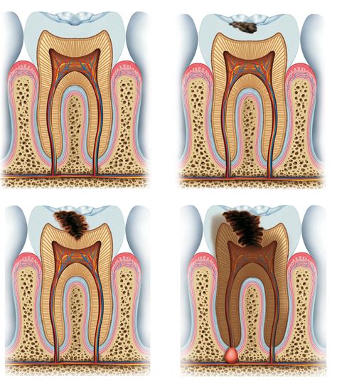 Dental Caries Uptodate at James Saavedra blog