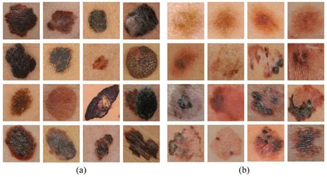 A Multi-Feature Fusion Framework for Automatic Skin Cancer Diagnostics