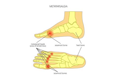 Ball of Foot Pain Running 的图像结果