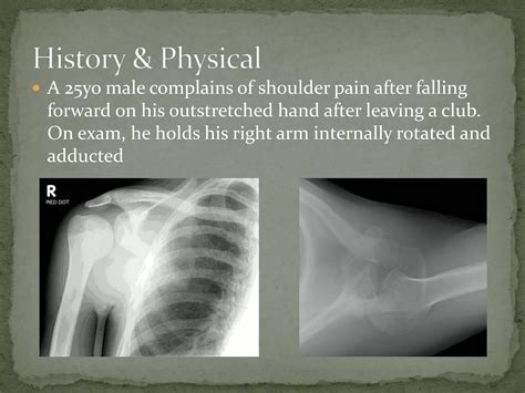 Image result for Posterior Shoulder Dislocation Sulcus Sign