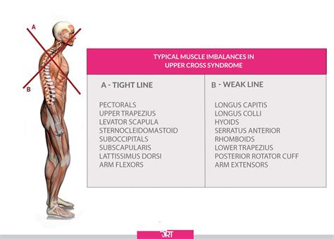 Upper Cross Syndrome Muscles Combining Manual Therapy And Exercise For