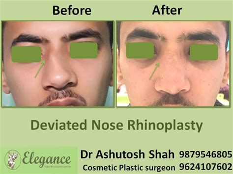Nose Hump Rhinoplasty Cost In Goa Velha, India