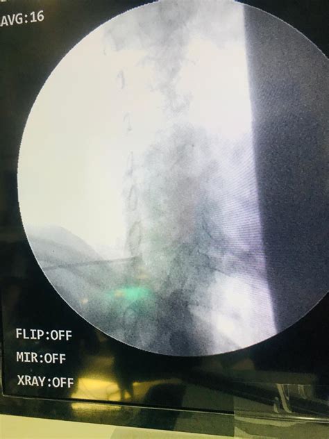 Image result for Epidural Injection Procedure