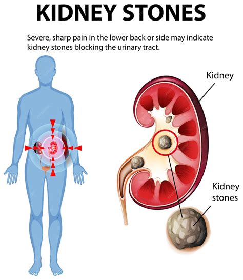 Free Vector | Understanding Kidney Stones and Pain