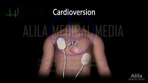 Image result for Cardioversion Steps