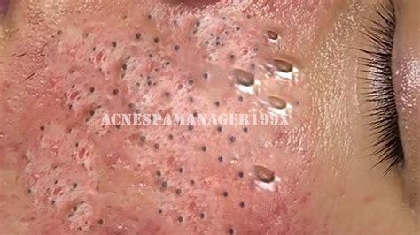 Image result for Exploding Pimples 2017