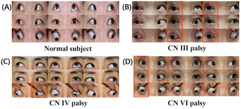 Artificial Intelligence for Diagnosing Cranial Nerve III, IV, and VI ...