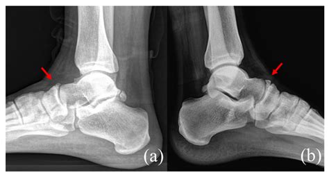 Navicular Bone Fracture Boot at Lucy Doak blog