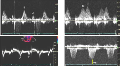 Noninvasive Prediction of Pulmonary Capillary Wedge Pressure in ...