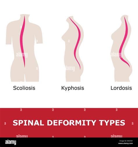 Lordosis Vs Kyphosis