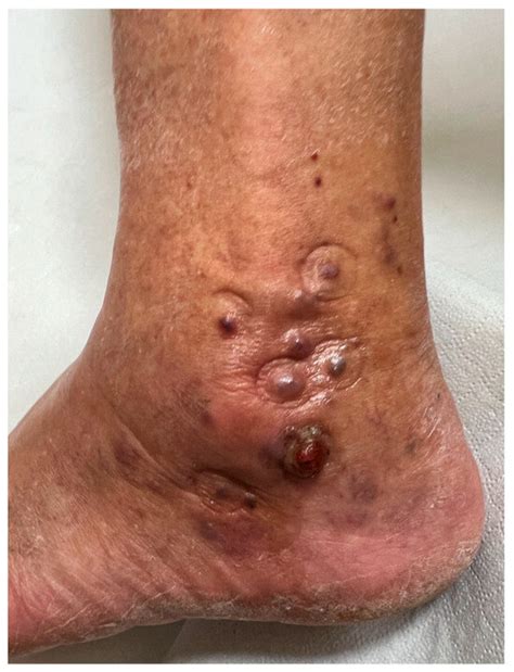 Non-Invasive Diagnostic Imaging in Kaposi Sarcoma Evaluation