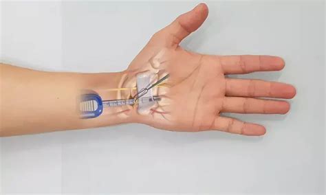 Endoscopic versus open carpal tunnel release, which has low incidence ...