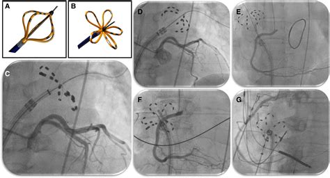 What Does Cardiac Spasm Mean at Max Redfern blog