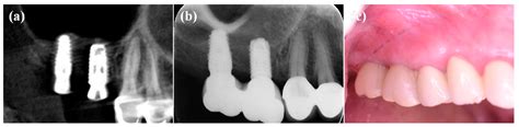 Development of a Surface-Functionalized Titanium Implant for Promoting ...