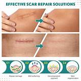 Buy Silicone Scar Sheets, Silicone Scar Tape(1.6” x 120” Roll-3M ...