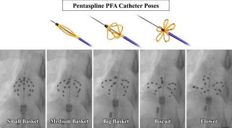 Lesion Morphometry of the Pentaspline Pulsed Field Ablation Catheter: Understanding Catheter ...
