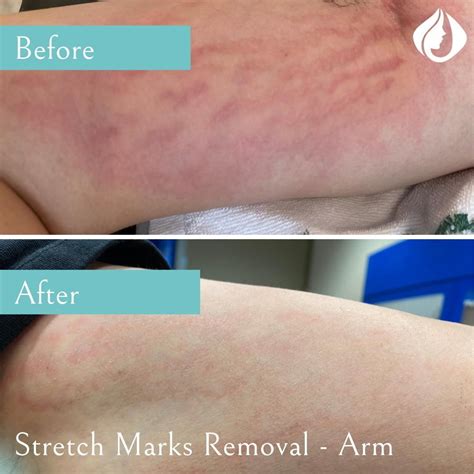 Stretch Marks Removal Toronto, North York, Markham | La Vitalité Med Spa