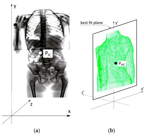 Combining 3D Structured Light Imaging and Spine X-ray Data Improves ...