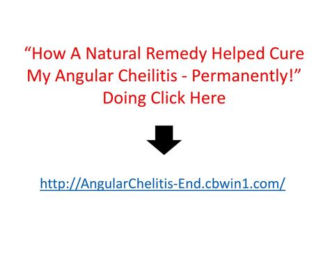 PPT - Cracks At Corner Of Mouth, Chelitis, Antifungal Cream For Angular Cheilitis, Treat Angular ...