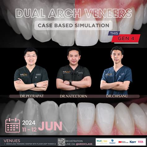 Dual Arch Veneers Gen 4 | LINE SHOPPING