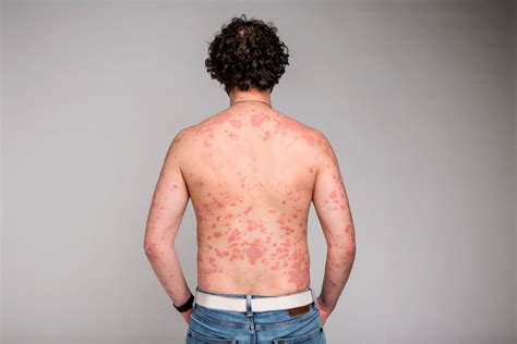 Psoriasis On Back