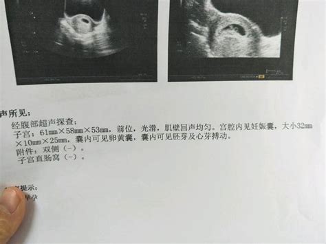怀孕7周不见胎心、胎芽，孕妈不妨再等等，多半是这3个原因！_腾讯新闻