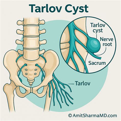 Sacral Tarlov Cyst Treatment