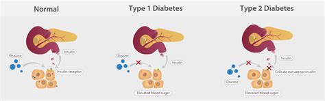 What is Diabetes? - Mindray India