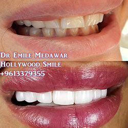 Emax Veneers Lebanon beirut