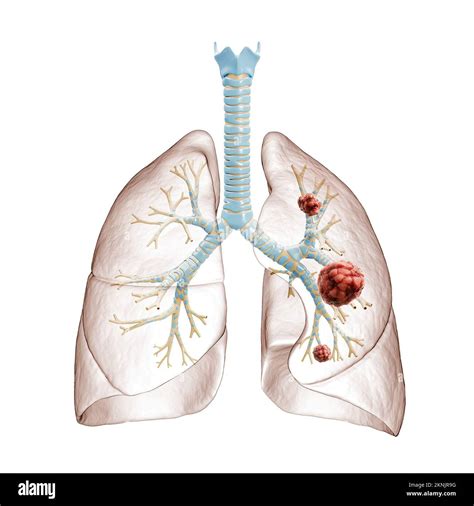 Lung Cancer Cells Diagram