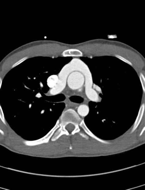 Switch Procedure 的图像结果