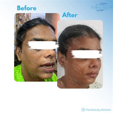 Best Gender Reassignment / Affirmation Surgery in Mumbai