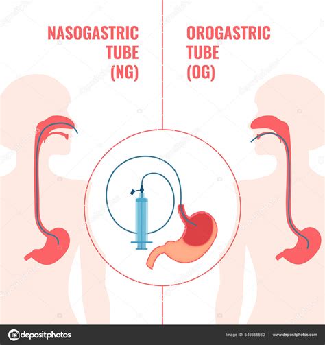Nasogastric and orogastric feeding tubes medical diagram Stock Vector ...