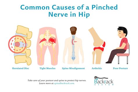 Pinched Nerve In Hip