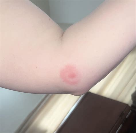 Bullseye rash? : r/DermatologyQuestions
