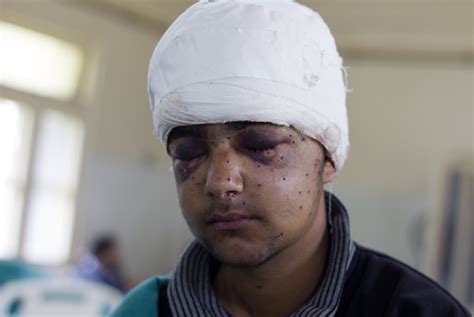 In Kashmir, Concern Over Pellet Guns Continues; CRPF Unable To Confirm ...