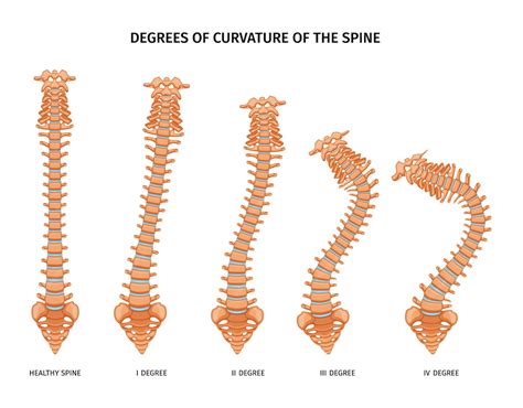 Free Vector | Spine structure anatomy set of isolated icons showing various degrees of spine ...