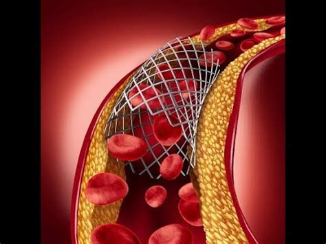 Understanding the Role of Imaging Techniques in Angioplasty