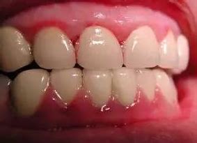 急 ! 急 ! 这是牙龈线性红斑么? 还是一般的牙龈红肿?_百度知道