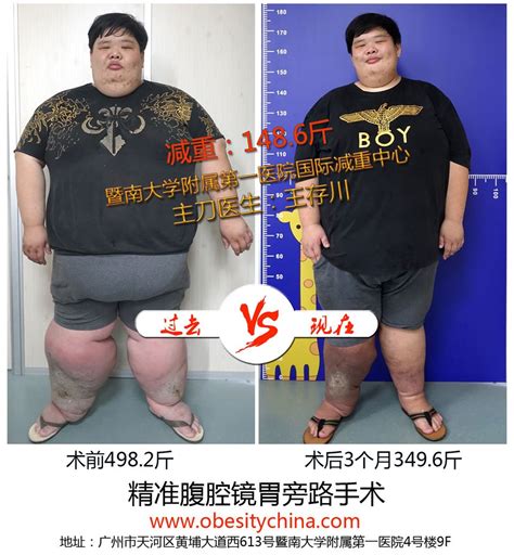 “中国第一胖”梁用，身高155、体重450，今减重200斤，妻子漂亮