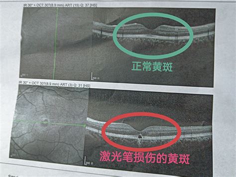激光笔成伤眼“凶器”，柳人医眼科医生发出警示：其损伤不可逆，切勿让孩子轻易接触-柳州市人民医院